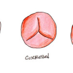 Aortenklappenstenose; Heike C. Ewert