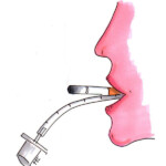 „Perioperatives Rauchen“; Heike C. Ewert