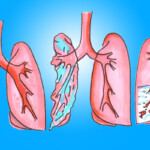 "Bilder einer Lunge", Heike C. Ewert